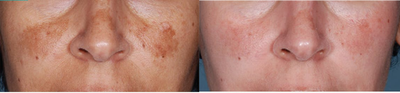 Chemical Peel before and after photo