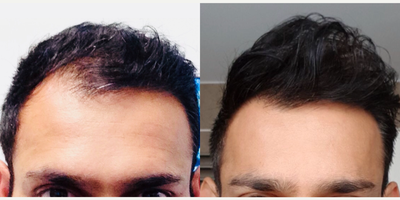 Hair Transplant before and after photo