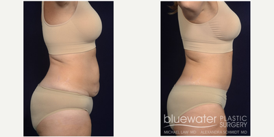 Mini Tummy Tuck before and after photo