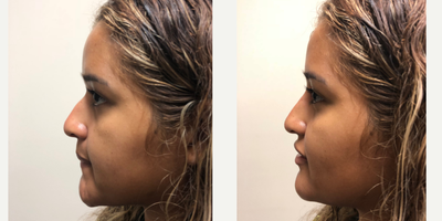 Nonsurgical Nose Job before and after photo