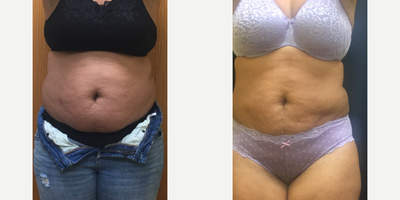 Smart Lipo before and after photo
