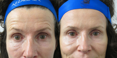 Botox before and after photo