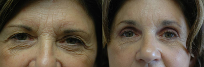 Brow Lift before and after photo