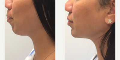 Chin Filler before and after photo