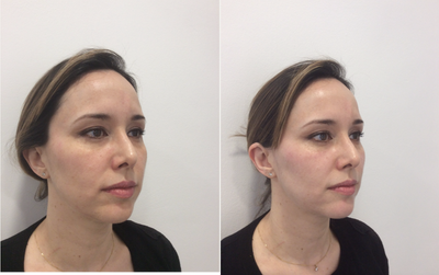 Dermal Fillers before and after photo