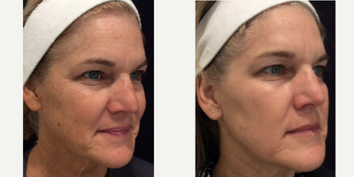 Fraxel Laser before and after photo