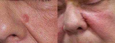 Mole Removal before and after photo