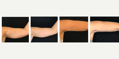 Emsculpt before and after photo