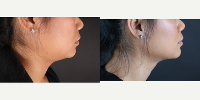 Kybella before and after photo