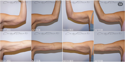 Arm Lift before and after photo