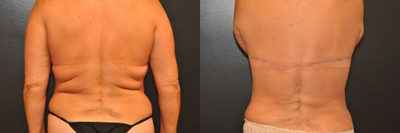 Liposuction before and after photo