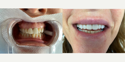 Teeth Whitening before and after photo