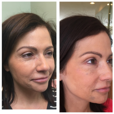 ALMI before and after photo