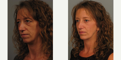 Facelift before and after photo