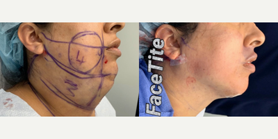 FaceTite before and after photo
