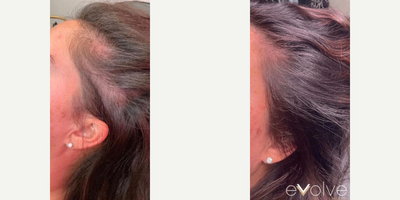 PRP for Hair Loss before and after photo