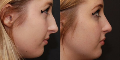 Rhinoplasty before and after photo