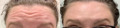 Botox before and after photo