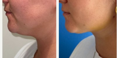 before and after image