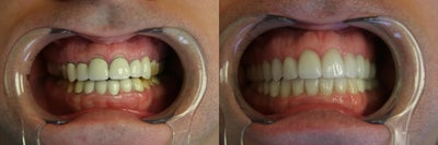 Dental Crown before and after photo