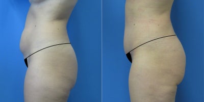Liposuction before and after photo