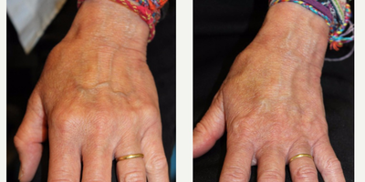 Radiesse before and after photo