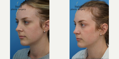 Rhinoplasty before and after photo