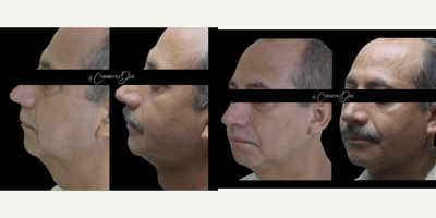 Vaser Liposuction before and after photo