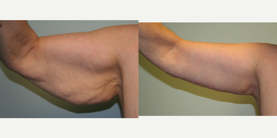 Arm Lift before and after photo
