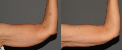 CoolSculpting before and after photo