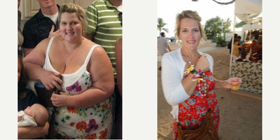 Gastric Bypass before and after photo