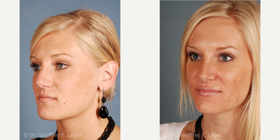 Rhinoplasty before and after photo