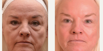 Skin Rejuvenation before and after photo