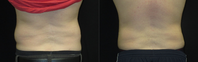 CoolSculpting before and after photo