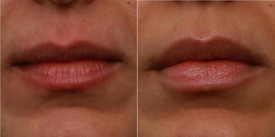 Lip Fillers before and after photo