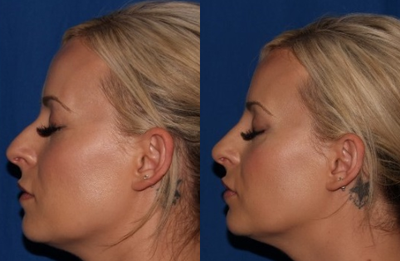 Nonsurgical Nose Job before and after photo