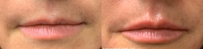 Restylane Refyne before and after photo