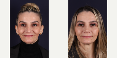 Revision Rhinoplasty before and after photo