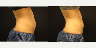 CoolSculpting before and after photo