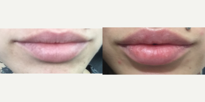 Lip Fillers before and after photo