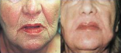 Skin Tightening before and after photo