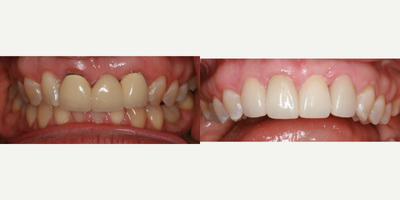 Dental Implants before and after photo