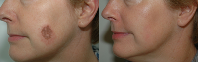 IPL before and after photo