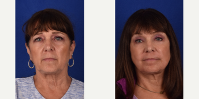 Mini Facelift before and after photo