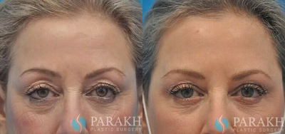 Eyelid Surgery before and after photo