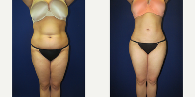 Liposuction before and after photo