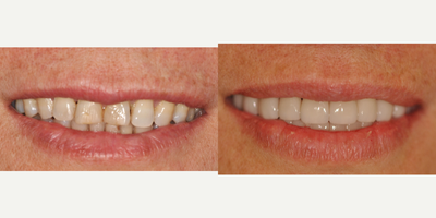 Smile Makeover before and after photo