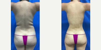 Vaser Liposuction before and after photo