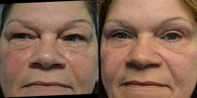 Eyelid Surgery before and after photo