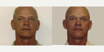 Facelift before and after photo